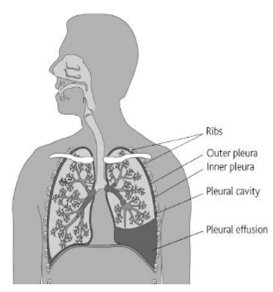 Diagram showing the collection of fluid which causes the need for a chest drain. Labels of the body read: Ribs, outer pleura, inner pleura, pleural cavity, pleural effusion